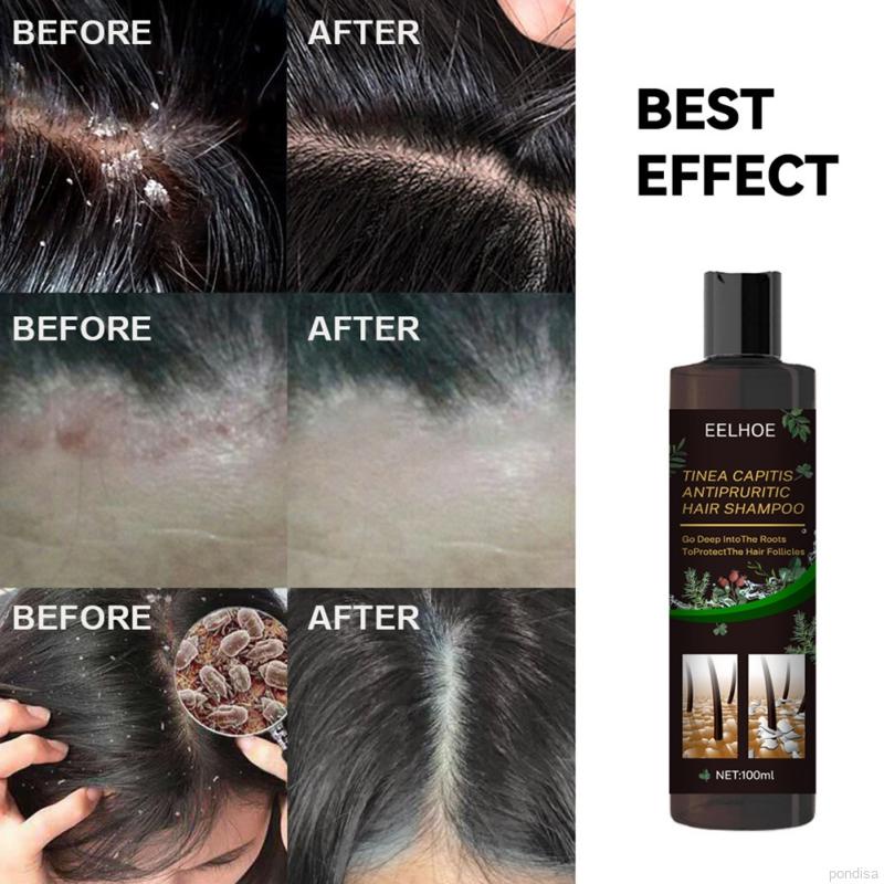 Hair Care Shampoo Relieve Itching Dandruff Conditioner Triple Organic ...