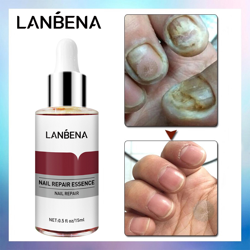 LANBENA Nail Repair Essence Serum Fungal Nail Treatment Remove