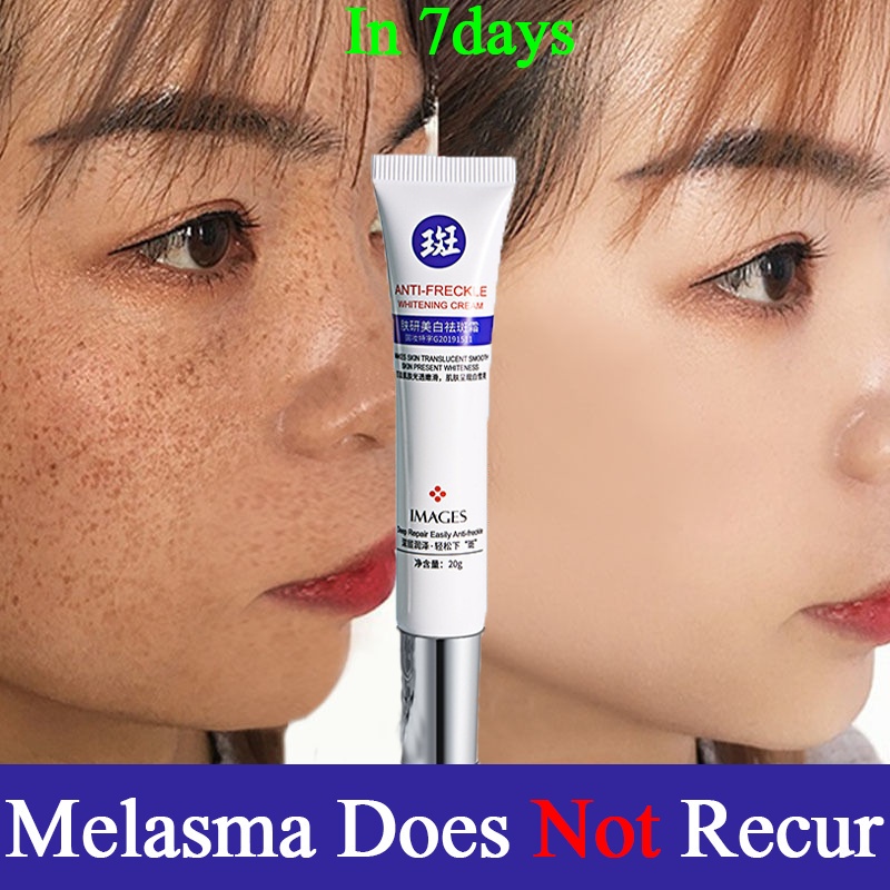 IMAGES Age Spots Remover Melasma and Pekas Remover Original Whitening Freckle Cream Original