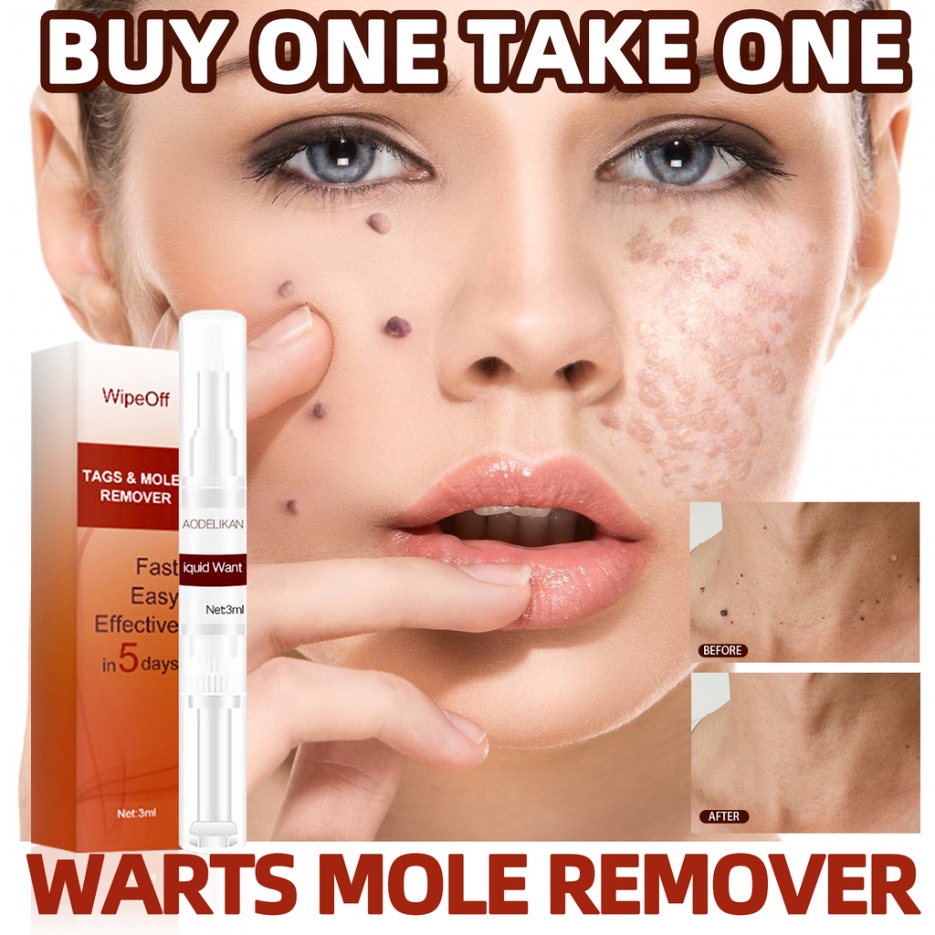 Warts mole remover cream original skin tag wart remover original ...