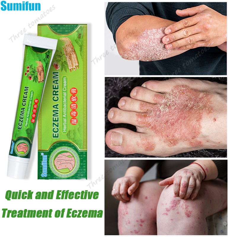 Mabisang Gamot Sa Eczema Sa Paa Paa Mesa 8966