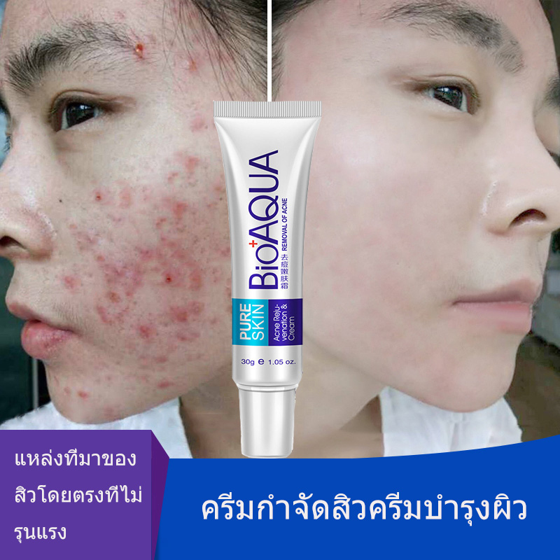 Do not let acne affect your beauty, acne treatment cream, raw materials, imported acne