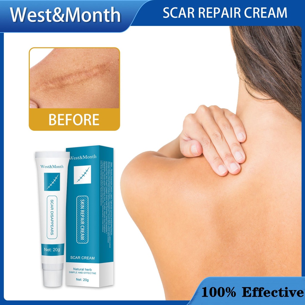 West&Month Acne Treatment  Dark Spot Remover Repair Strech Marks 20g Acne Scar Pimples Marks Acne Sc