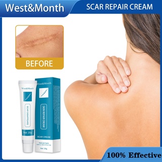 West&Month Acne Treatment  Dark Spot Remover Repair Strech Marks 20g Acne Scar Pimples Marks Acne Sc #1