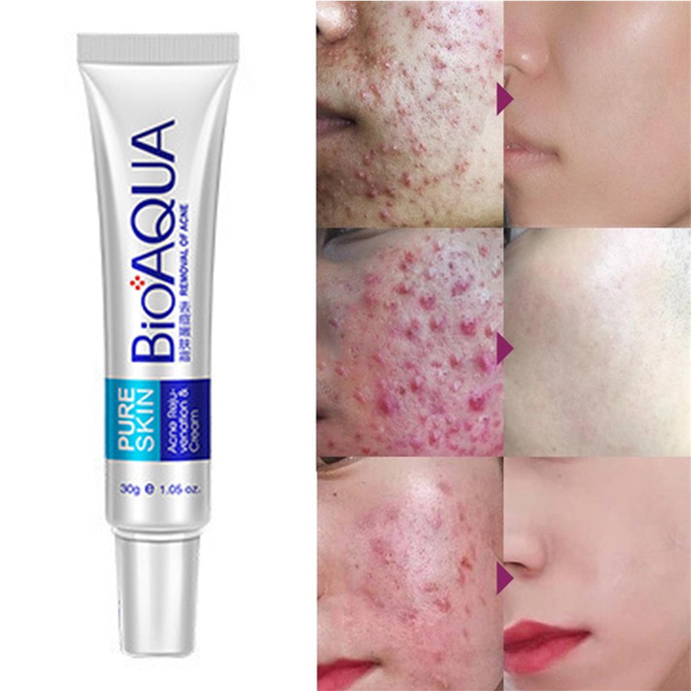 Acne Treatment Face Cream Anti Acne Scar Removal Pimple Blackhead Moisturizing Whiten Oil Control Shrink Pores Skin Care 30g Shopee Philippines