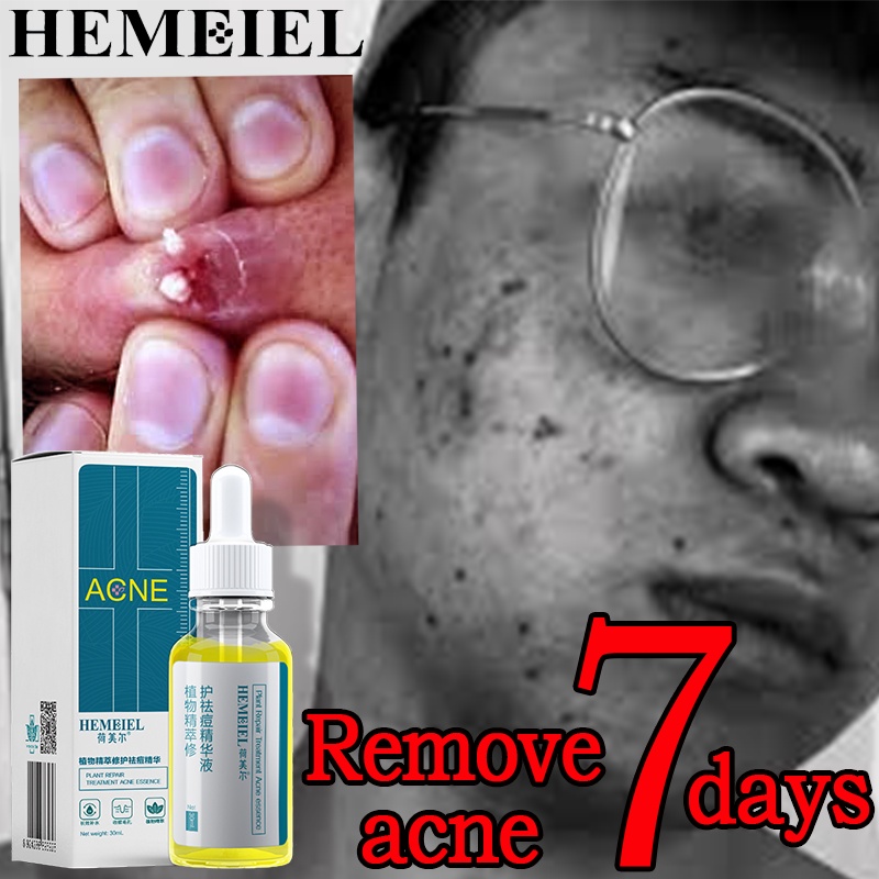 HEMEIEL - Acne Scar Remove pimple Marks Anti Acne Blackhead Serum Acne