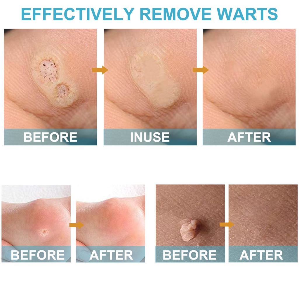 4PCS/Set Painless Warts Removal Genital Warts & Wart Remover Original ...