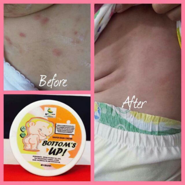 BOTTOMS UP DIAPER RASHES CREAM Shopee Philippines