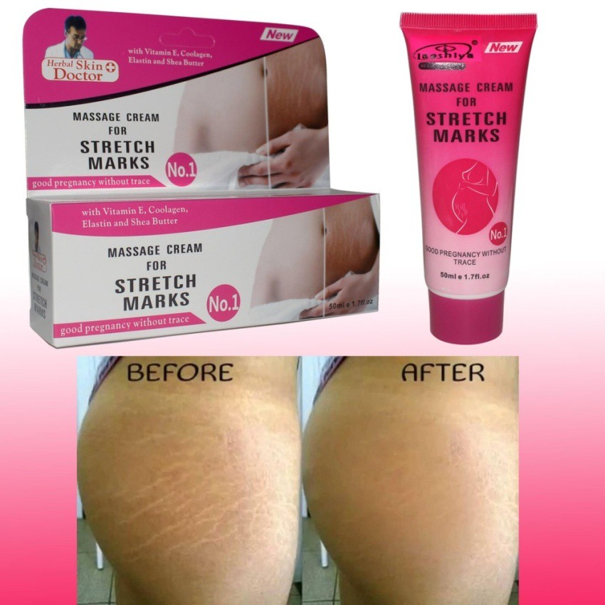 massage cream for stretch marks