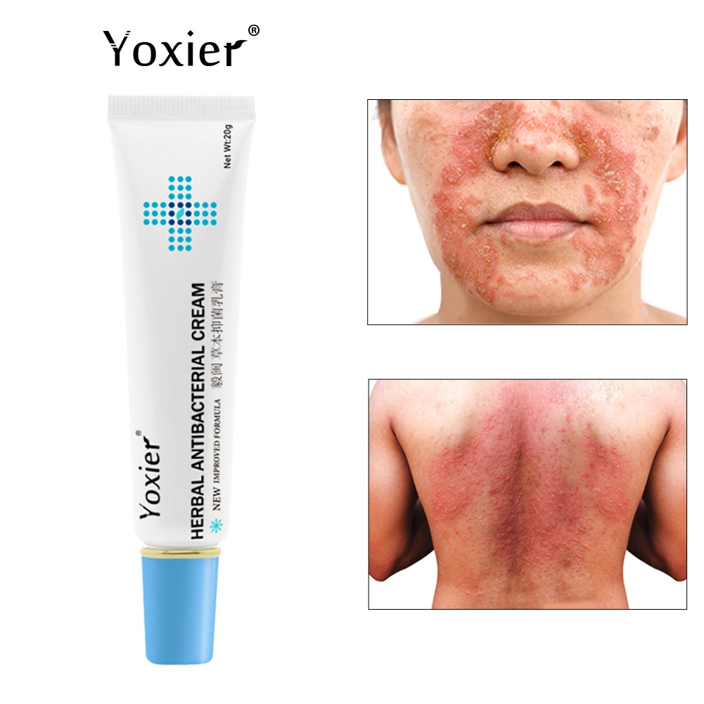 Yoxier Herbal Antibacterial Cream Psoriasis Cream Antiitch Relief Eczema Skin Rash Urticaria