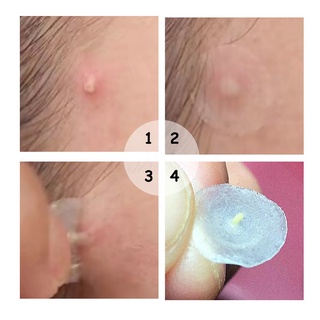 Low price activity Breylee Acne Treatment Set 6 pcs (facial cleanser,acne scars removal gel ,serum , #2