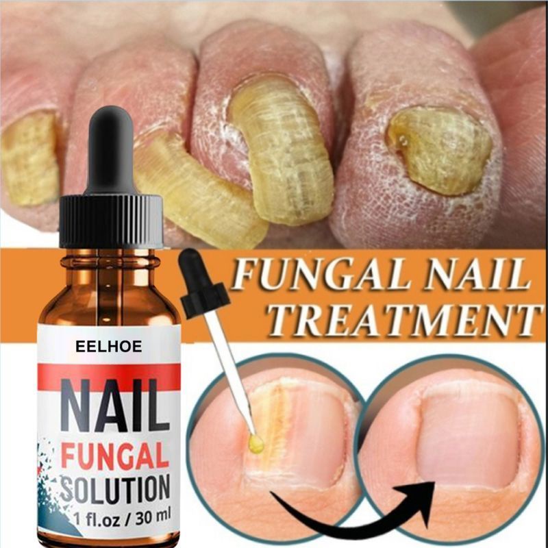 Nail Fungisol Antifungal Nail Fungus Treatment Quickly Bad Nails Fix Bad Nails Inhibit Fungal