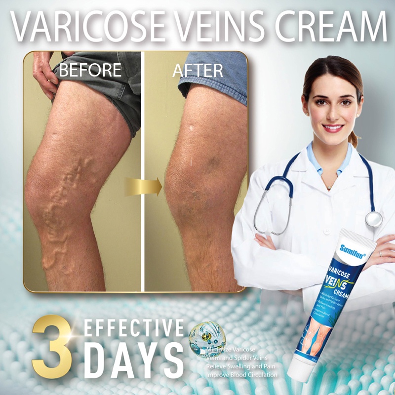 Varicose Vein Remover Cream Veins Effective Patch Original Veins Care ...