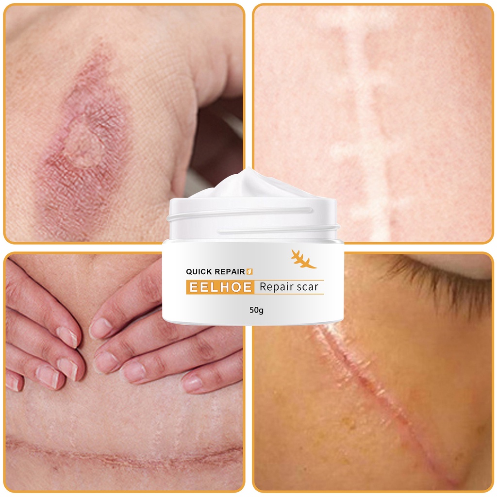 Scar Remover Cream Skincare Repair Blackhead Acne Spots Acne Scar