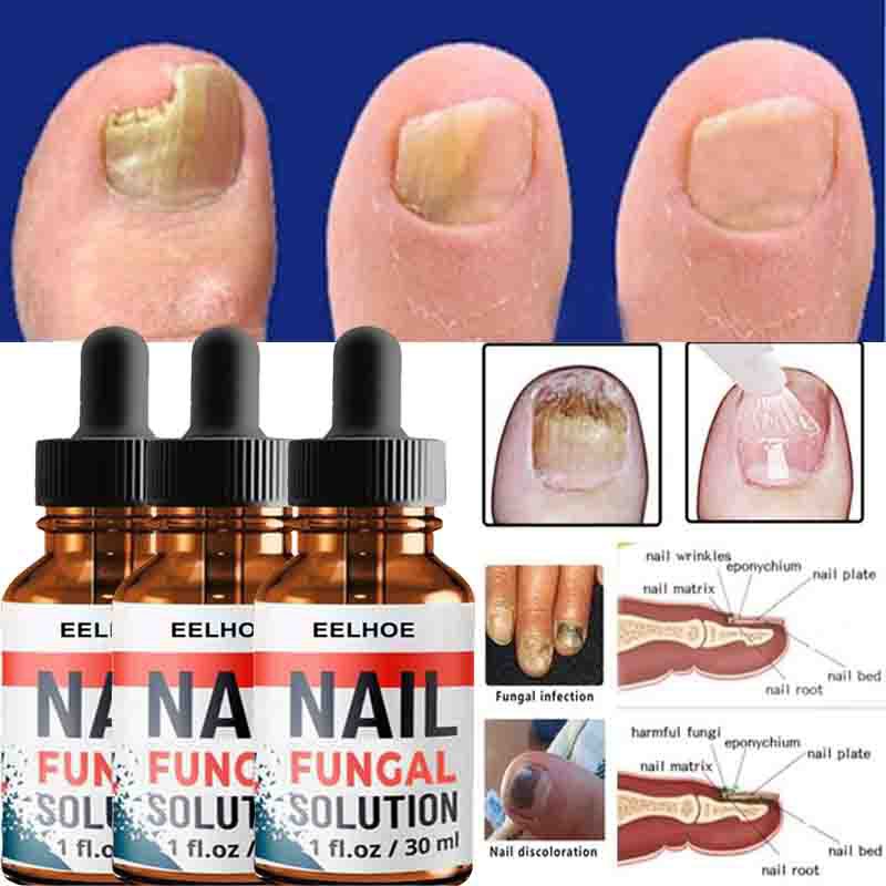 nail-repair-serum-nail-fungal-treatment-serum-onychomycosis-paronychia