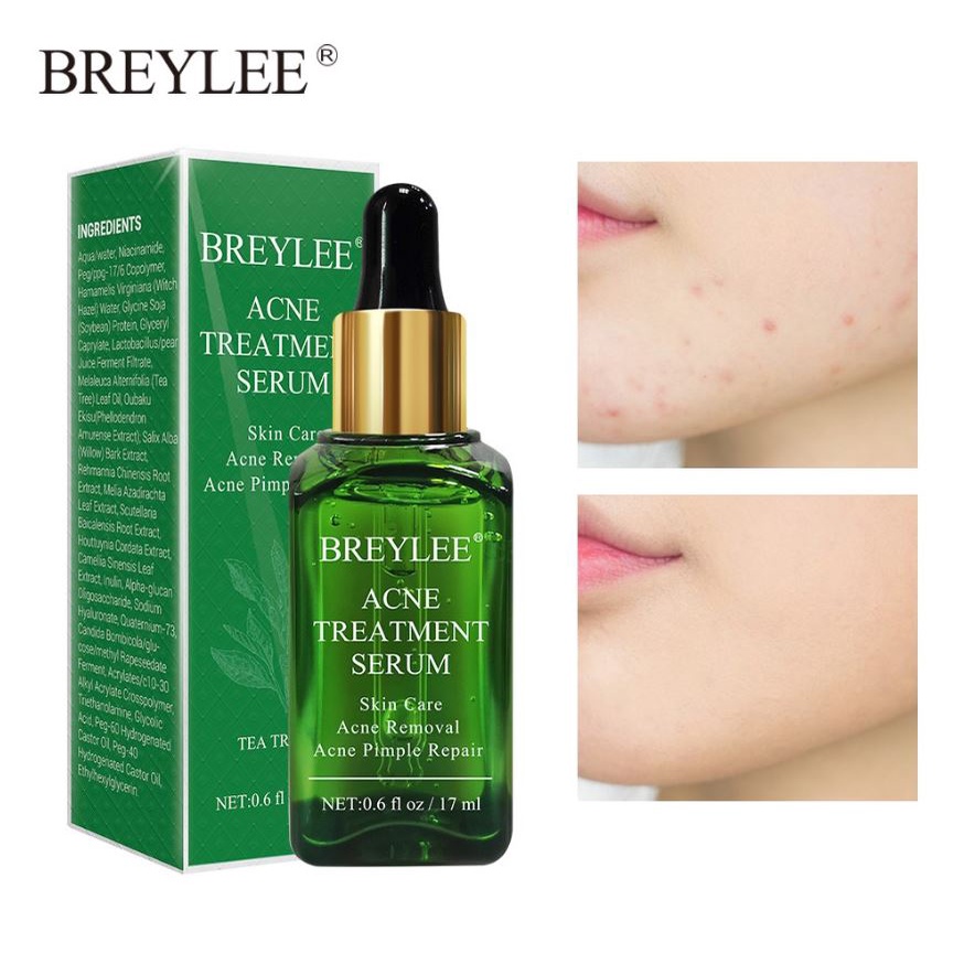 BREYLEE Acne Treatment Serum Essence Anti Acne Scar Removal Cream