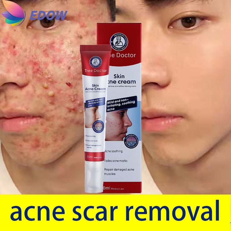 Acne remover Pimple Remover Marks keep face moisturized, whiten skin