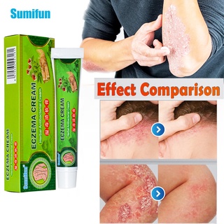 Eczema Cream Dermatitis Psoriasis Ointment For Skin Diseases Ointment For Reatment Skin Itching