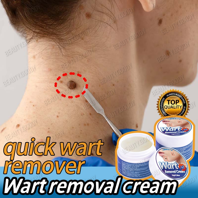 Warts Remover Original Cream Kasoy Oil Cream Kulugo Mole Skin Tag Wart Remover Wart Removal