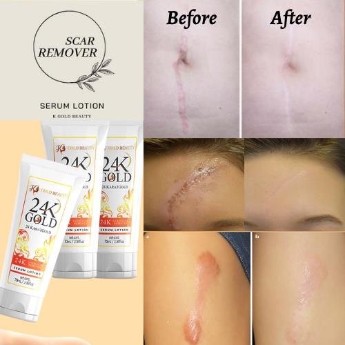 K Gold Beauty Scar Remover Serum Lotion, Buy 1 Take 1 Scar Remover