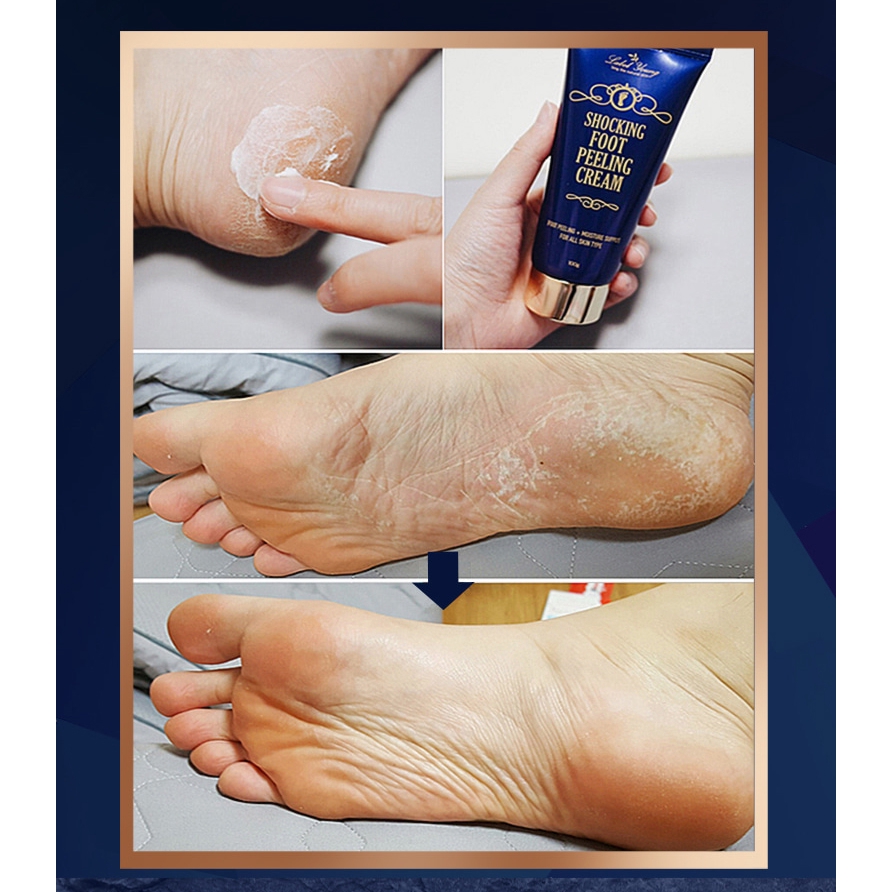 cream for feet peeling