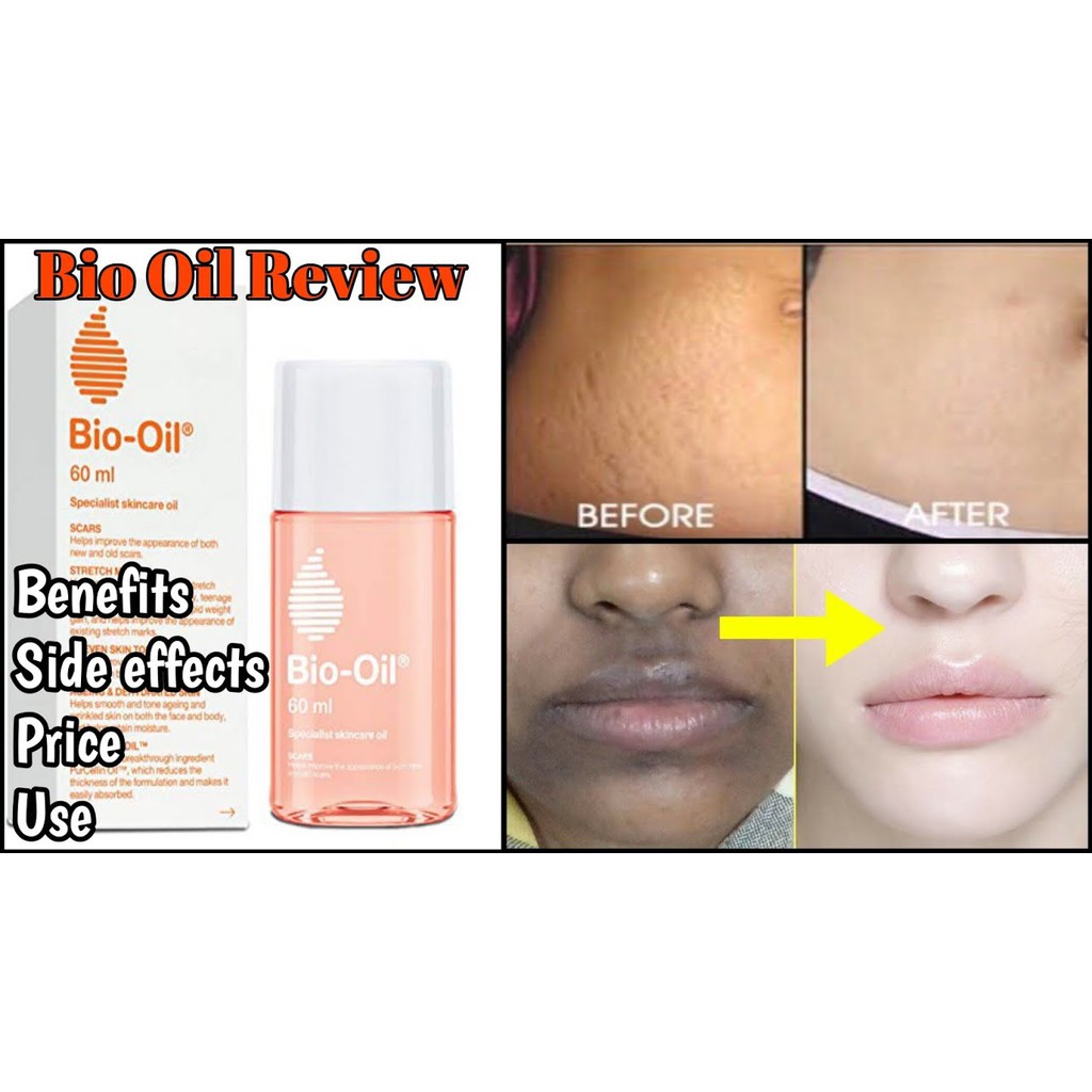 Bio Oil 100 Australia 200ml Skin Care Acne Stretch Mark Makeup Remover Scar Remove Uneven Skin Tone Shopee Philippines