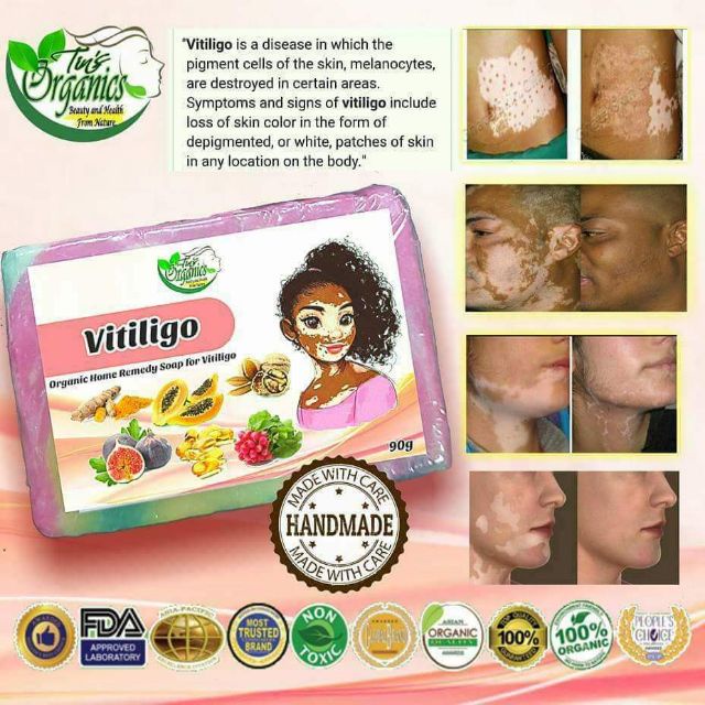 Body Wash & Soap Vitiligo Soap (Treatment for Vitiligo) Shopee