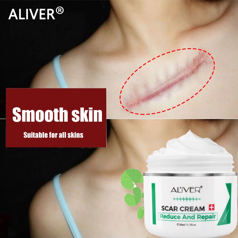 COD ALIVER old Scar Remover for legs50ml peklat remover acne Surgical Stretch Marks Repair Cream