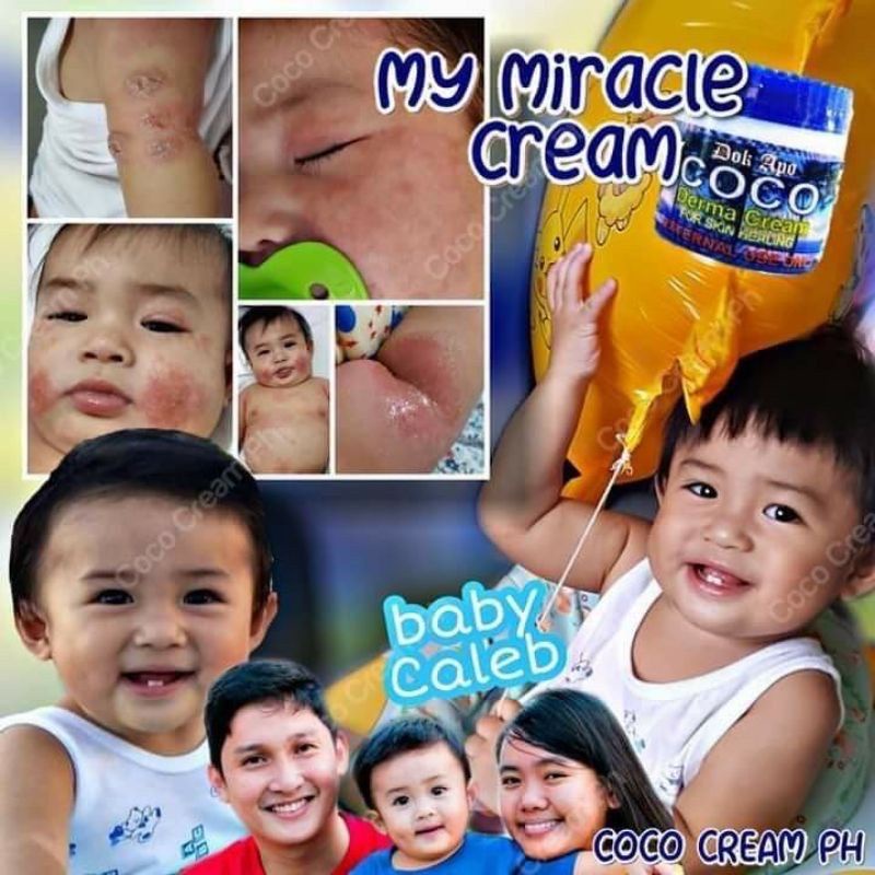 ORGANIC COCONUT CREAM ORIGINAL DOK APO FOR ECZEMA DERMATITIS PSORIASIS EFFECTIVE FOR BABIES