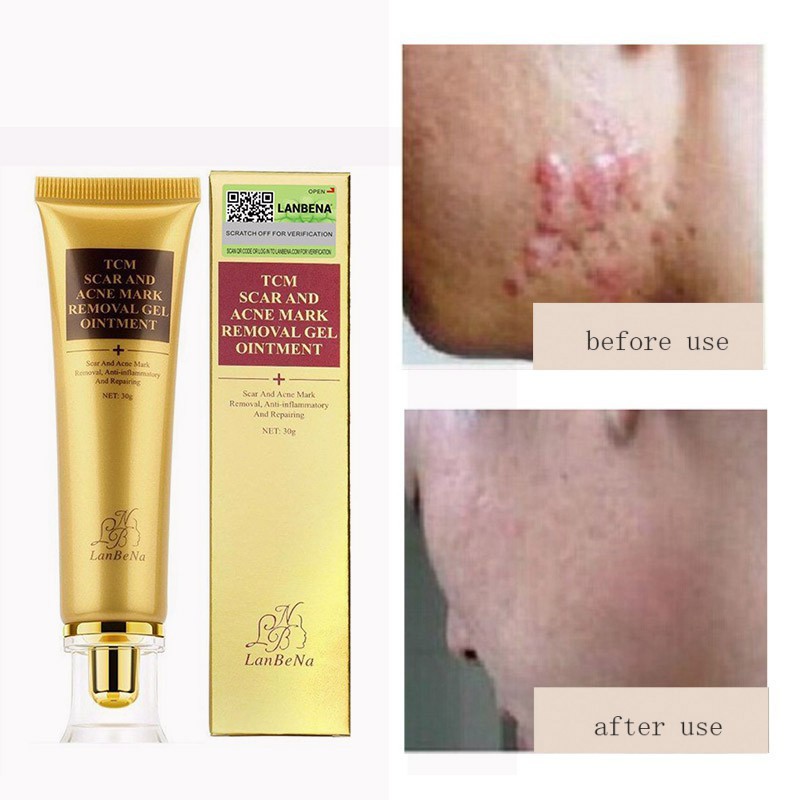 Acne Scar Removal Cream is rated the best in 04/2024 BeeCost