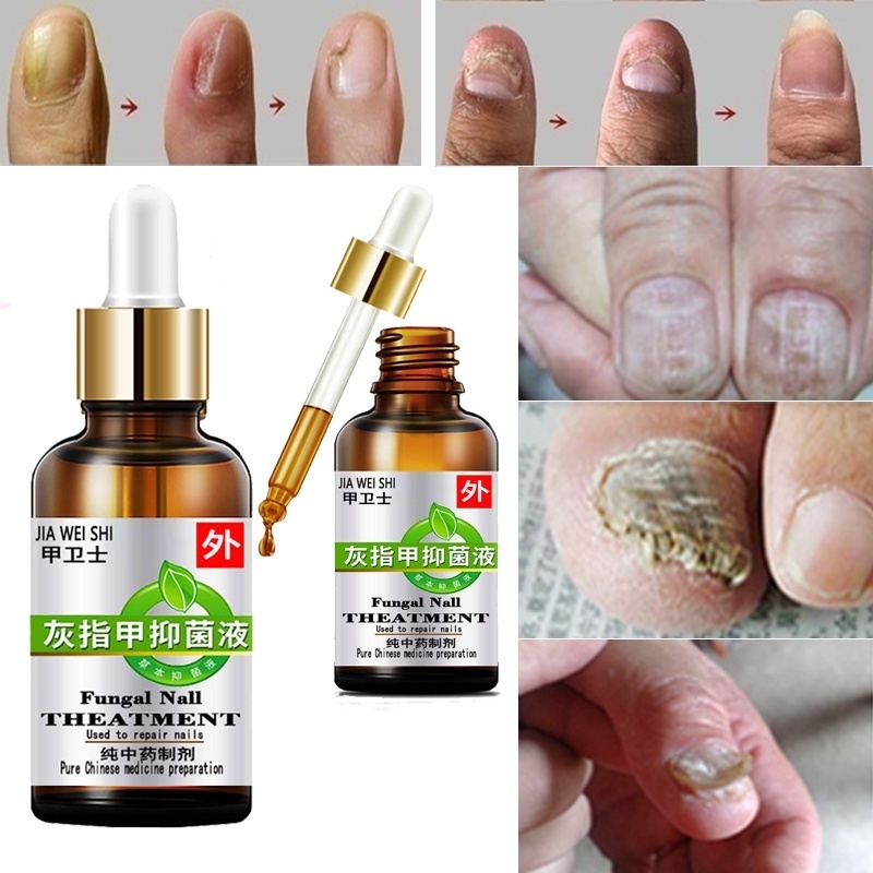 2022NEW!antifungal maximum strength TOENAIL FUNGUS athlete foot fungus