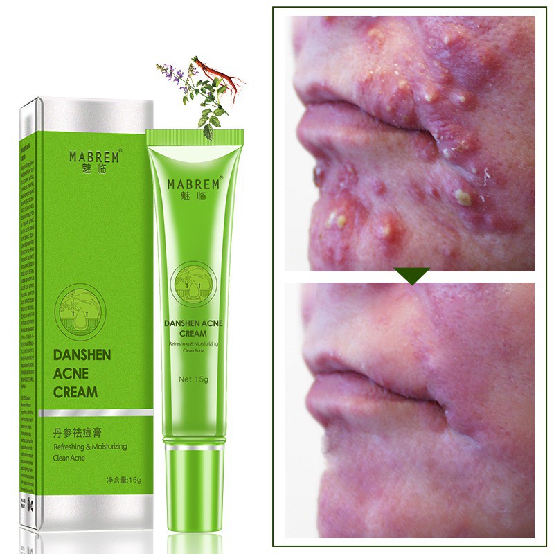danshen acne cream