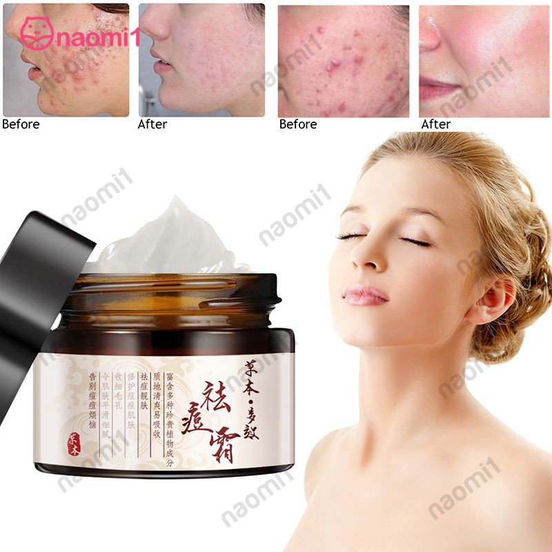 anti spot cream for face