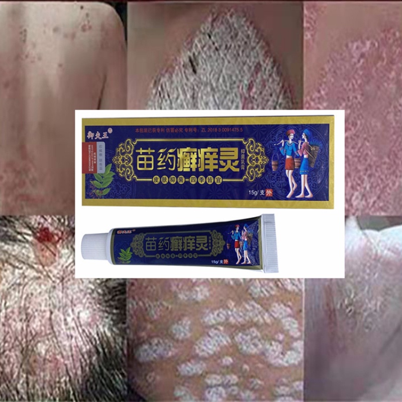 Skin fighter cream original Psoriasis Psoriasis Hands Ringworm and