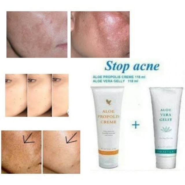 aloe propolis creme acne