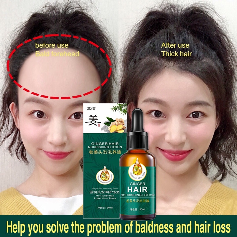 30ml Hair Growth Serum Ginger Hair Treatment Essence Anti Hair Loss Hair  Nutrient Solution | Shopee Philippines