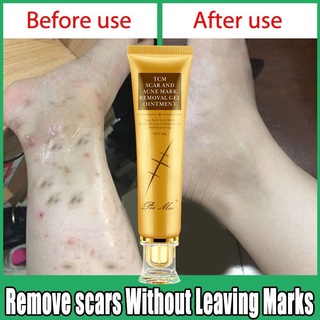 Hot sell old Scar Remover for legs peklat remover acne Surgical Stretch ...