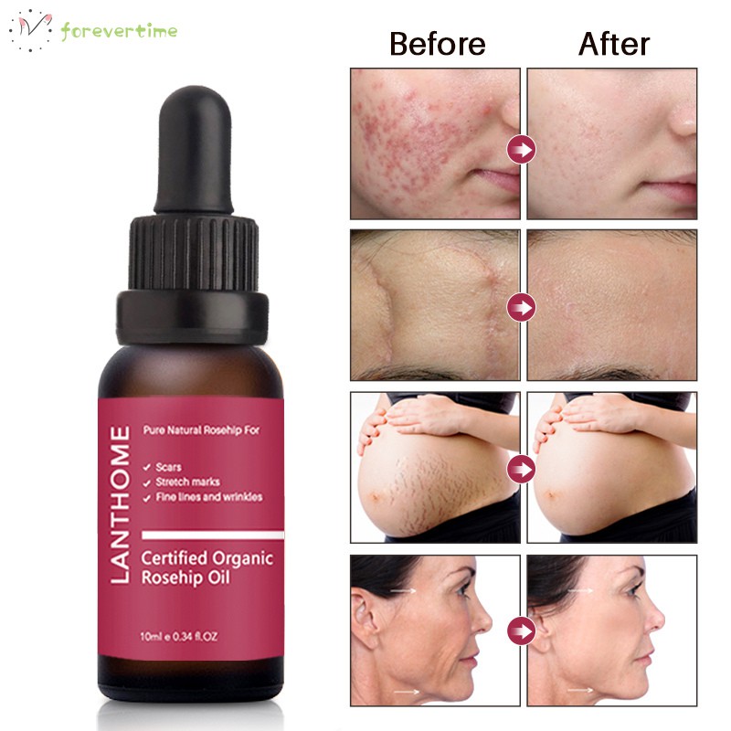 moisturizer for acne marks