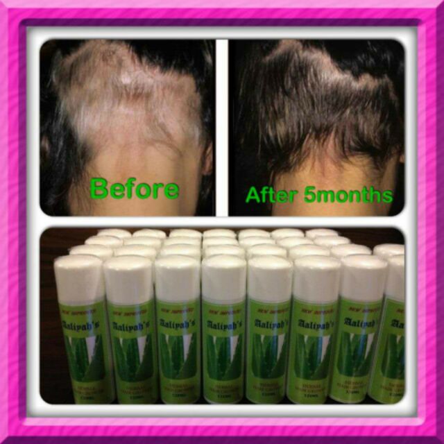 Alopecia Areata Cure Shopee Philippines