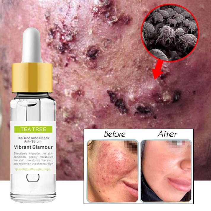 Herbal Acne Treatment AntiAcne Clear Pimples Facial Serum/Cream Tea Tree Oil Shopee Philippines