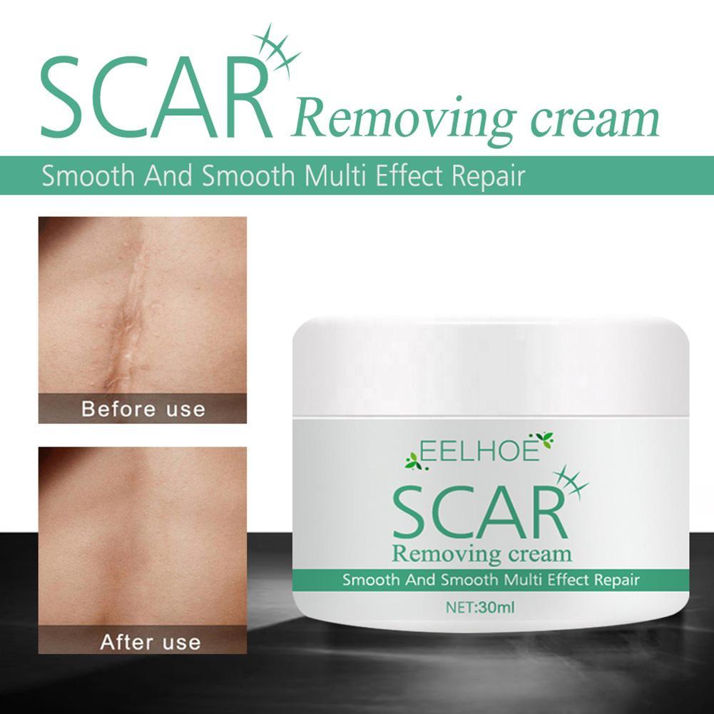 eelhoe scar removal cream