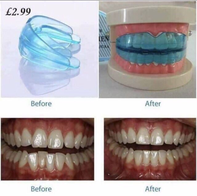 Teeth Trainer Alignment Shopee Philippines