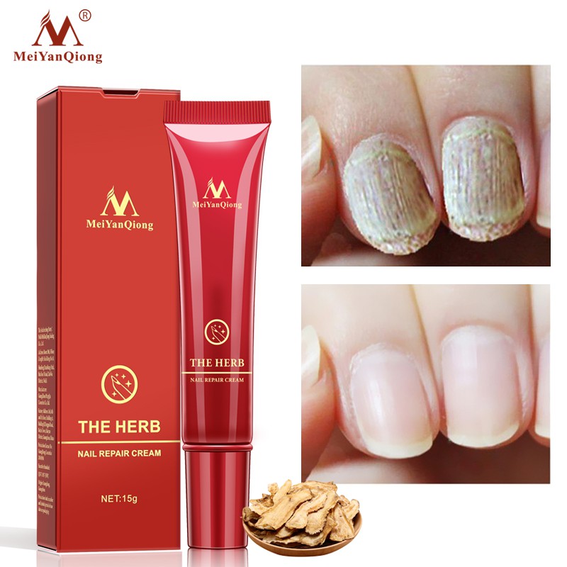 MeiYanQiong The Herb Nail Repair Cream 1Piece Nail and Foot Care (15g) |  Shopee Philippines