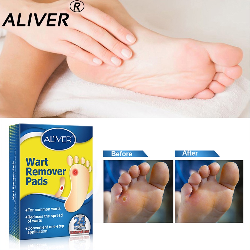 How To Use Wart Patches : Warts: How To Identify, Causes, Types ...
