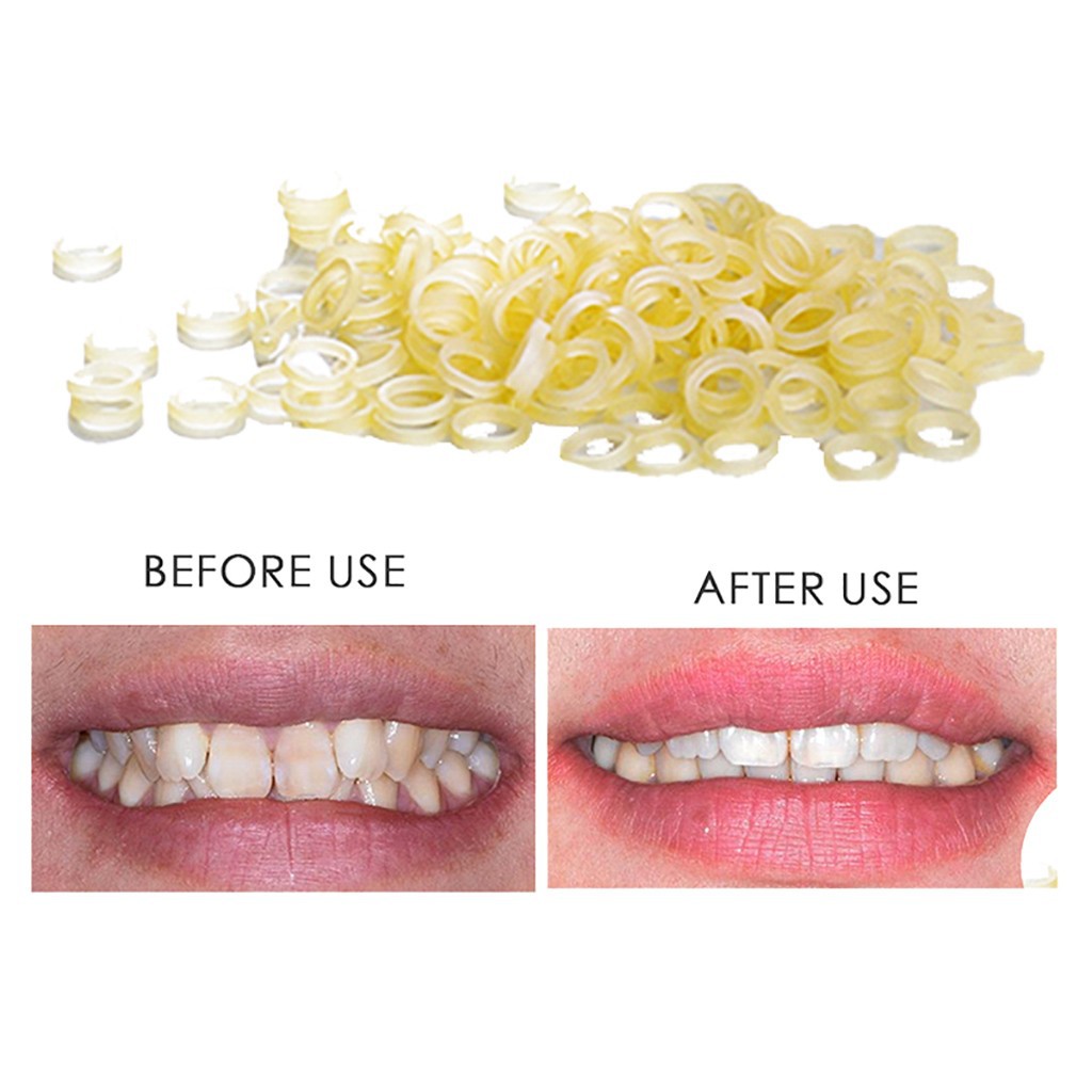 dental braces rubber bands