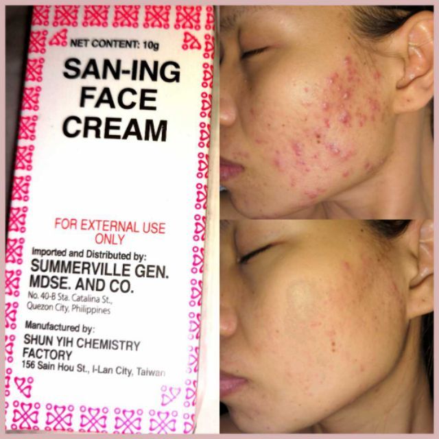 sulfur cream for face