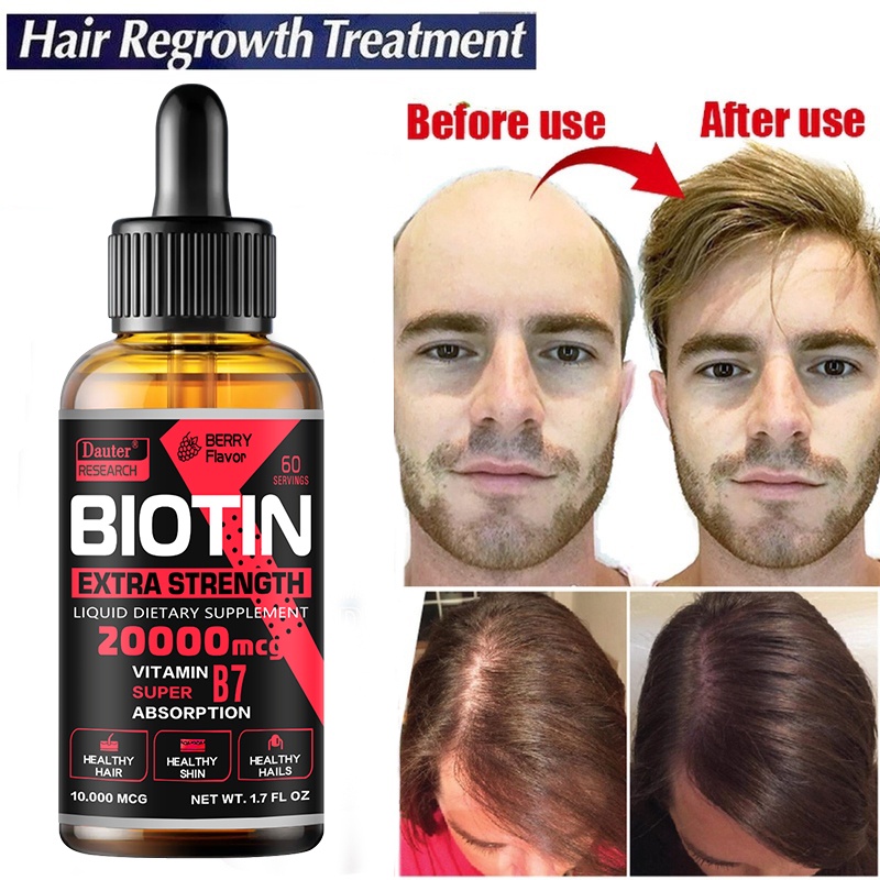 2022 Biotin Fast Hair Growth Oil Hair Regrowth Serum Hair Thinning  Treatment Hair Growth Liquid Anti-Hair Loss for Women & Men | Shopee  Philippines