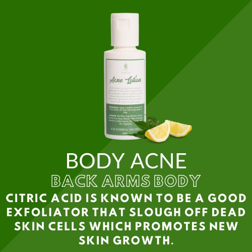 [ ACNE REMOVAL LOTION ] Greenika Acne Lotion For Bacne Arms Back Body Acne Scar Spot Remover