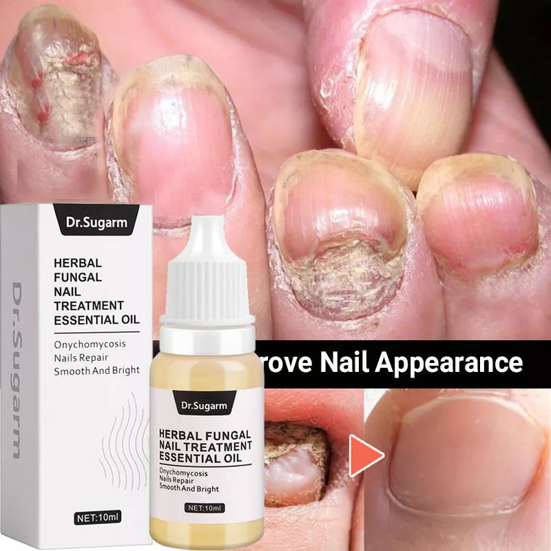 Nail Fungus Treatment Serum Anti Fungal Nail Gel Polish Hand Foot Care