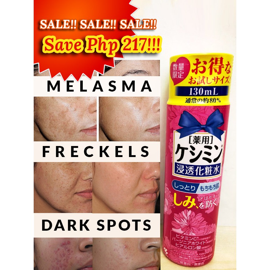 best toner for freckles